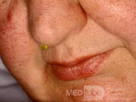 The Fluorescein Test for CSF Rhinorrhea