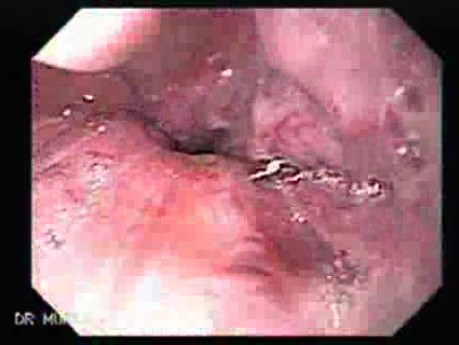 Esophageal Ulcer - Post Sclerotherapy - Visualization of the Ulcer