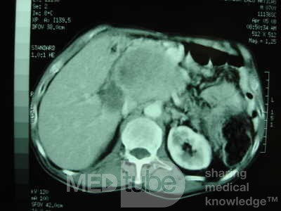 Gastric Ulcer with Gastrocolic fistula due to a Zollinger-
 Ellison Syndrome (22 of 33)