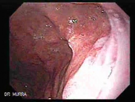 Hiatus Hernia (2 of 3)