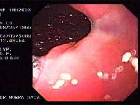 Banding of Esophageal Varices - Two Weeks Follow Up