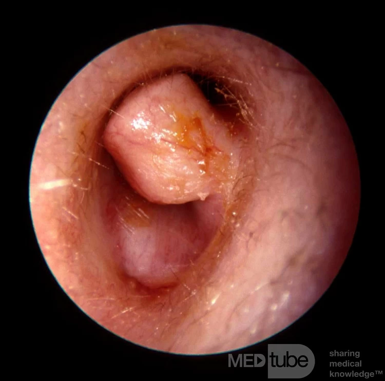 Large Osteoma Occluding External Canal