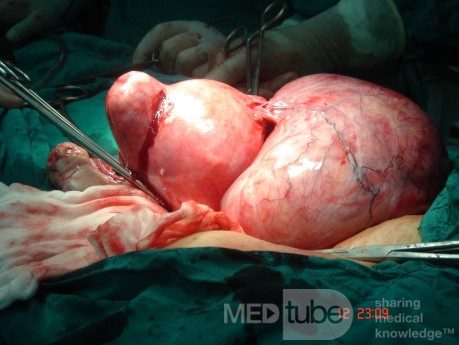 Huge Broad Ligament Degenerated Myoma