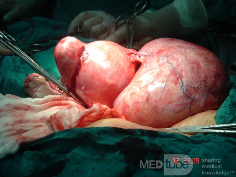 Huge Broad Ligament Degenerated Myoma