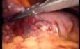 Gastrointestinal Stromal Tumor - GIST (45 of 65)