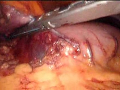 Gastrointestinal Stromal Tumor - GIST (45 of 65)