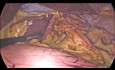 Sleeve Gastrectomy with Hiatal Hernia