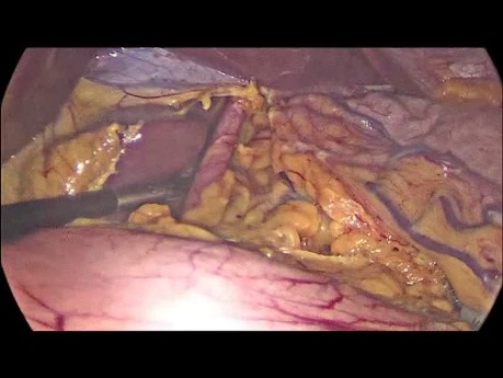 Sleeve Gastrectomy with Hiatal Hernia