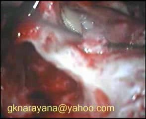 Cholesteatoma - Canal Up Mastoidectomy Incision - Part 2 - Grafting, Ossiculoplasty
