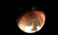 An 8 Year Old Patient with a Pumpkin Seed in his Right Primary Bronchus