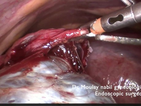Para Ovarian Cystectomy on 20 Weeks Pregnancy