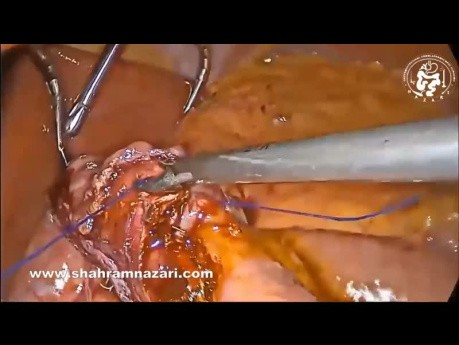 Conversion of Vertical Sleeve Gastrectomy to a Mini Gastric Bypass