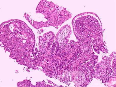 Ovarian Carcinoma Metastatic to Stomach and Duodenum (15 of 20)