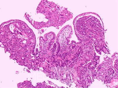 Ovarian Carcinoma Metastatic to Stomach and Duodenum (15 of 20)