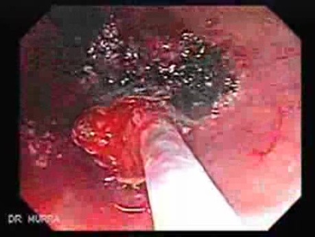 Tubulo - Villous Rectal Adenoma - Endoscopy (13 of 35)