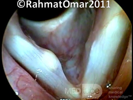 Vocal Fold Cyst