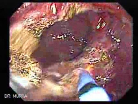 Multiple Adenomatous Polyps Of The Rectum (22 of 37)