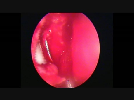 Bilateral Endoscopic DCR at the same session