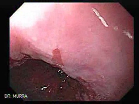 Barrett's Esophagus of long segment - 6 months after APC therapy(11 of 11)