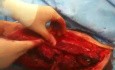 Anteriolateral Thigh Free Flap