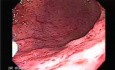 Endoscopy of severe gastritis