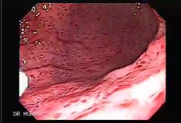 Endoscopy of severe gastritis