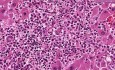 Acute myeloid leukemia - Histopathology - Liver