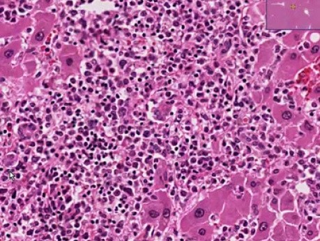 Acute myeloid leukemia - Histopathology - Liver