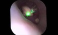 RIRS in Anomalous Kidney Use of Up to Date 6.3Fr Ureteroscope
