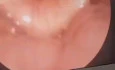 Rt Sided Arytenoid Dislocation with Hx of Long Intubation