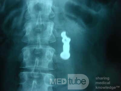 Dental Prothesis Found in the Jejuno (9 of 9)