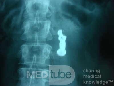 Dental Prothesis Found in the Jejuno (9 of 9)