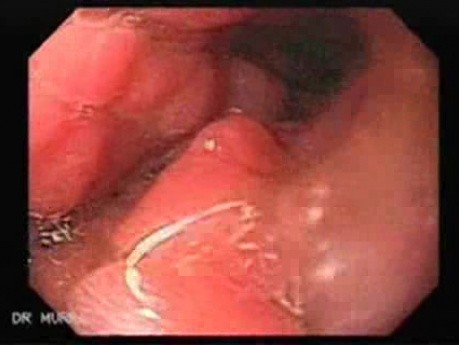 Leather Bottle Stomach - Endoscopy (5 of 9)