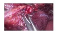 Laparoscopic Lymph Node Dissection in Supine Position