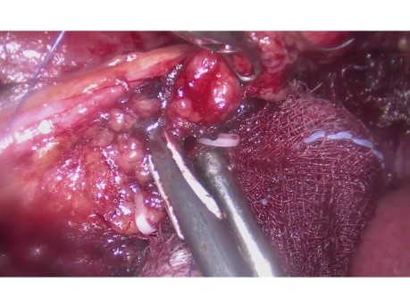 Laparoscopic Lymph Node Dissection in Supine Position