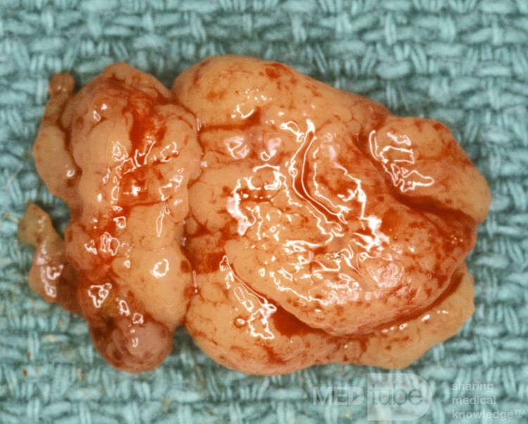 Adenoidectomy Surgical Specimen
