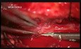 DAVF - Foix-Alajuanine Syndrome - microsurgical trapping using intraoperative SEP/MEP monitoring and ICG-videoangiography