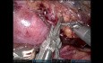 Horseshoe Kidney Donor Nephrectomy: Possible with ICG