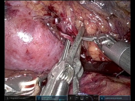 Horseshoe Kidney Donor Nephrectomy: Possible with ICG