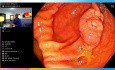 Cecal Colon, 20 Millimeters Flat Polyp, Underwater Hybrid Polypectomy