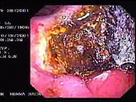 Ulcer at Anastomosis of a Billorth II Gastrectomy (1 of 4)
