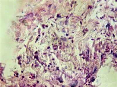 Esophageal Candidiasis Infected with Bacteria (6 of 6)