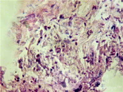 Esophageal Candidiasis Infected with Bacteria (6 of 6)