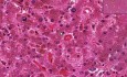 Hemochromatosis - Histopathology - Liver