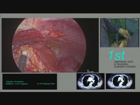 Subxiphoid Uniportal VATS Thymomectomy and Extended Thymectomy