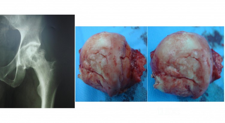 AVN femoral head