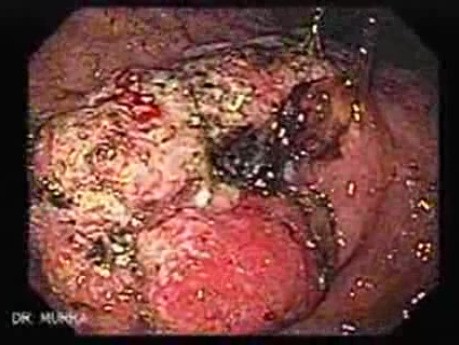 Adenocarcinoma of the Antrum (1 of 5)
