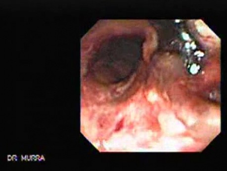 Tracheal Endoscopy - view through the thin endoscope 2/5