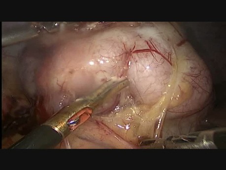 Wondering Fibroid Below Liver