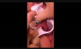 Laser Haemorrhoids